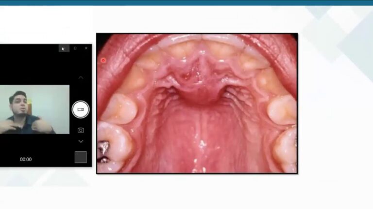 Granitos en el cielo de la boca: Causas, síntomas y tratamiento