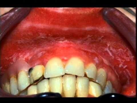 Placas blancas en la lengua: Causas y tratamientos