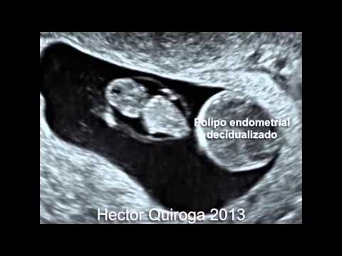 Polipos durante el embarazo: Causas, síntomas y tratamientos